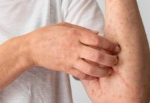 Kemenkes RI : 29 Kasus Cacar Monyet Terkonfirmasi dan 10 Suspek, Kenali Gejalanya