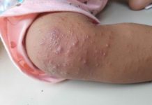 Waspada! Jakarta Dihebohkan Penularan Gondongan dan Flu Singapura ke Siswa Sekolah, Begini Situasinya